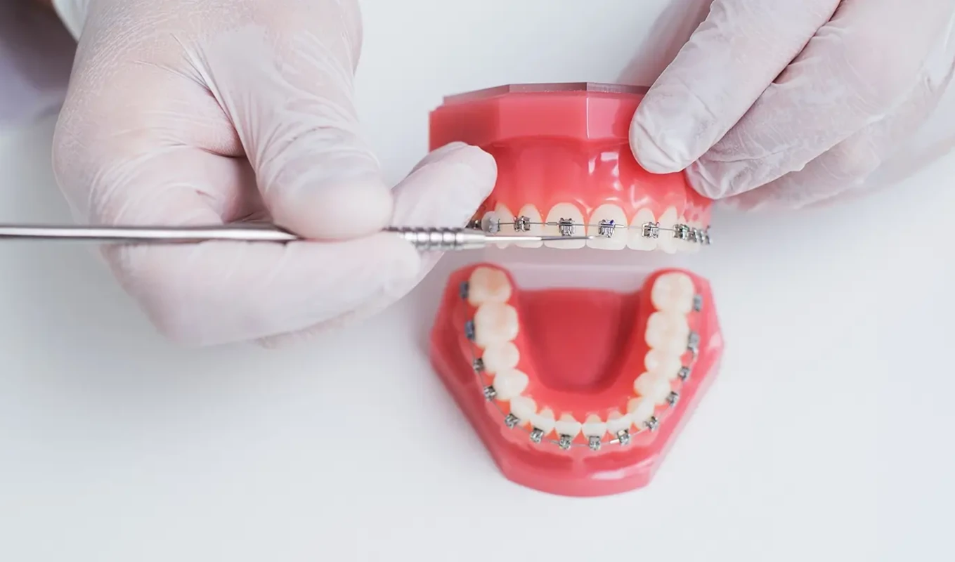 Zahnarzt zeigt an Zahnmodell eine feste Zahnspange mit Brackets und Draht